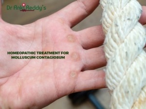 Homeopathic Treatment for Molluscum Contagiosum