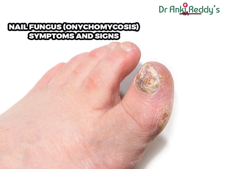 Nail Fungus (Onychomycosis) Symptoms and Signs