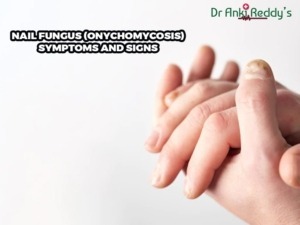 Nail Fungus (Onychomycosis) Symptoms and Signs