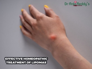 Effective Homeopathic Treatment of Lipomas