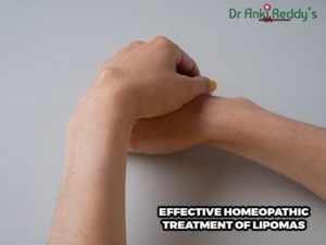 Effective Homeopathic Treatment of Lipomas