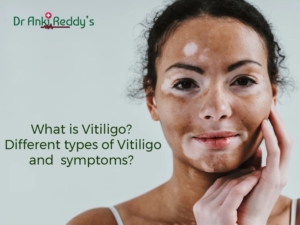 What is Vitiligo? Different types of Vitiligo and symptoms?