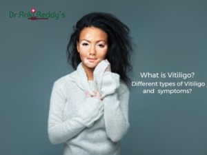 What is Vitiligo? Different types of Vitiligo and symptoms?