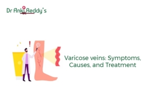 Varicose veins: Symptoms, Causes, and Treatment
