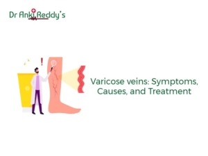 Varicose veins: Symptoms, Causes, and Treatment