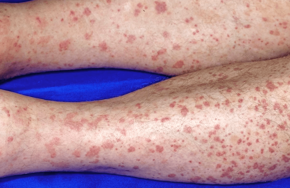 5 things to know about Vasculitis Treatment