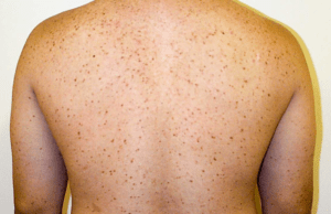 Urticaria Pigmentosa Symptoms, Diagnosis, and Treatment