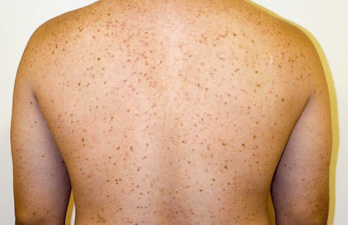 Urticaria Pigmentosa Symptoms, Diagnosis, and Treatment