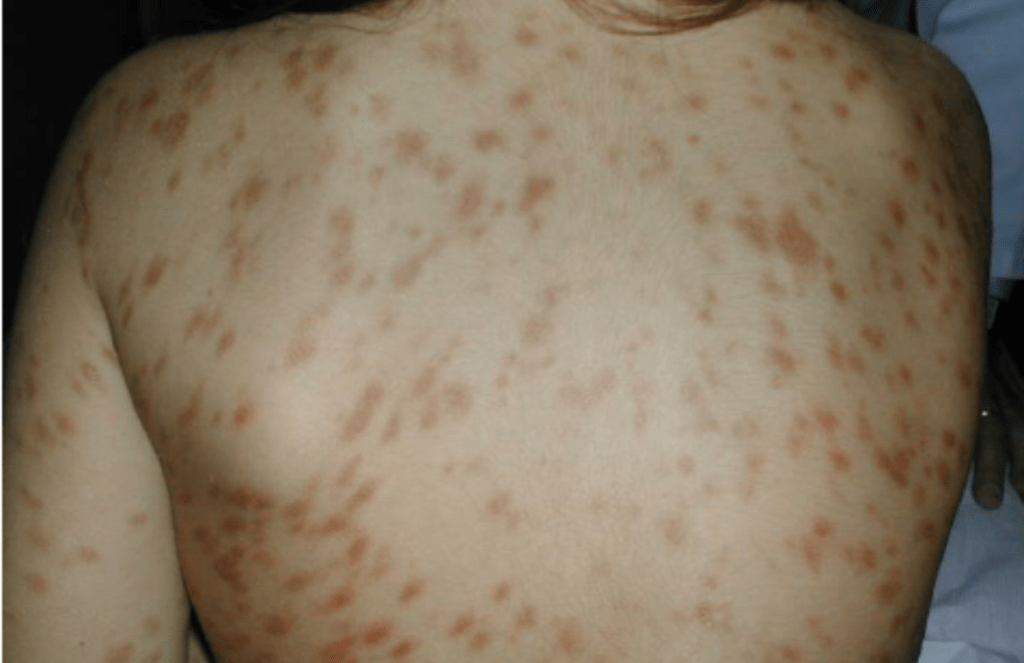 Urticaria Pigmentosa Symptoms, Diagnosis, and Treatment