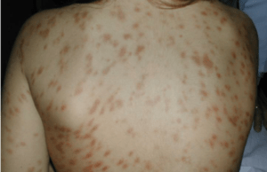 Urticaria Pigmentosa Symptoms, Diagnosis, and Treatment