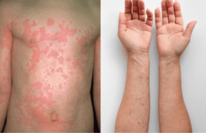 Difference between urticaria and urticaria pigmentosa