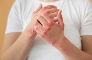 Difference between urticaria and urticaria pigmentosa
