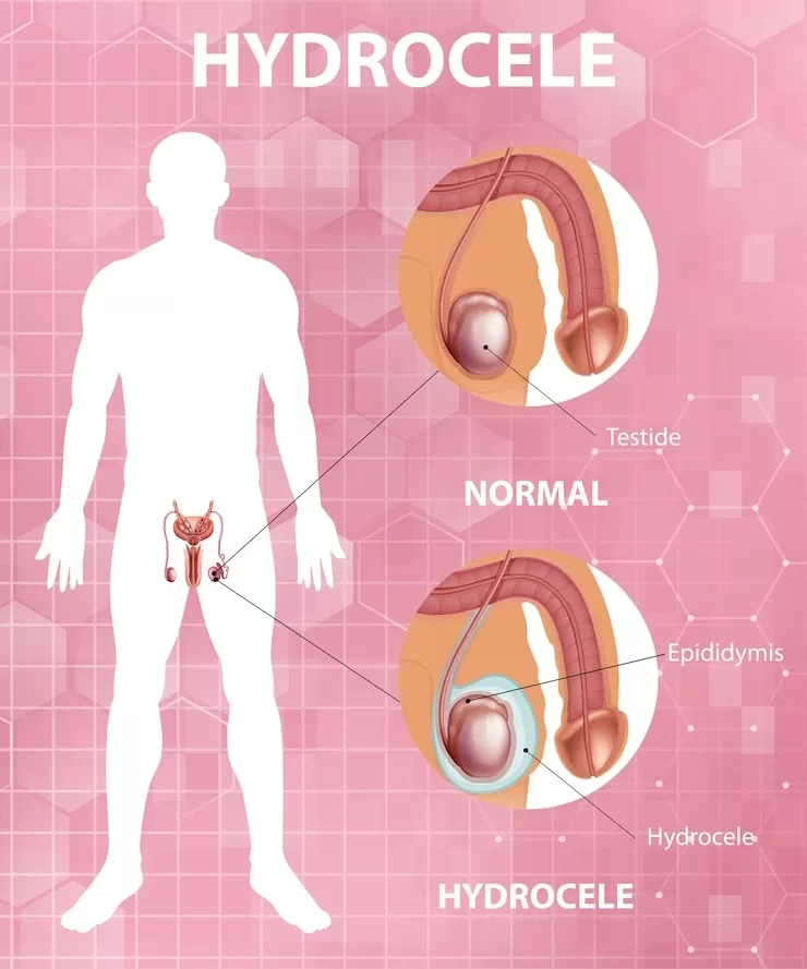 Hydrocele and Hydrocele homeopathic medicine effect?