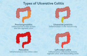 What are the various types of ulcerative colitis?