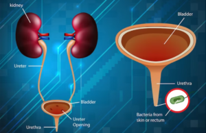 The Six Secrets of Urinary Tract Infection