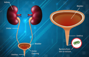 The Six Secrets of Urinary Tract Infection