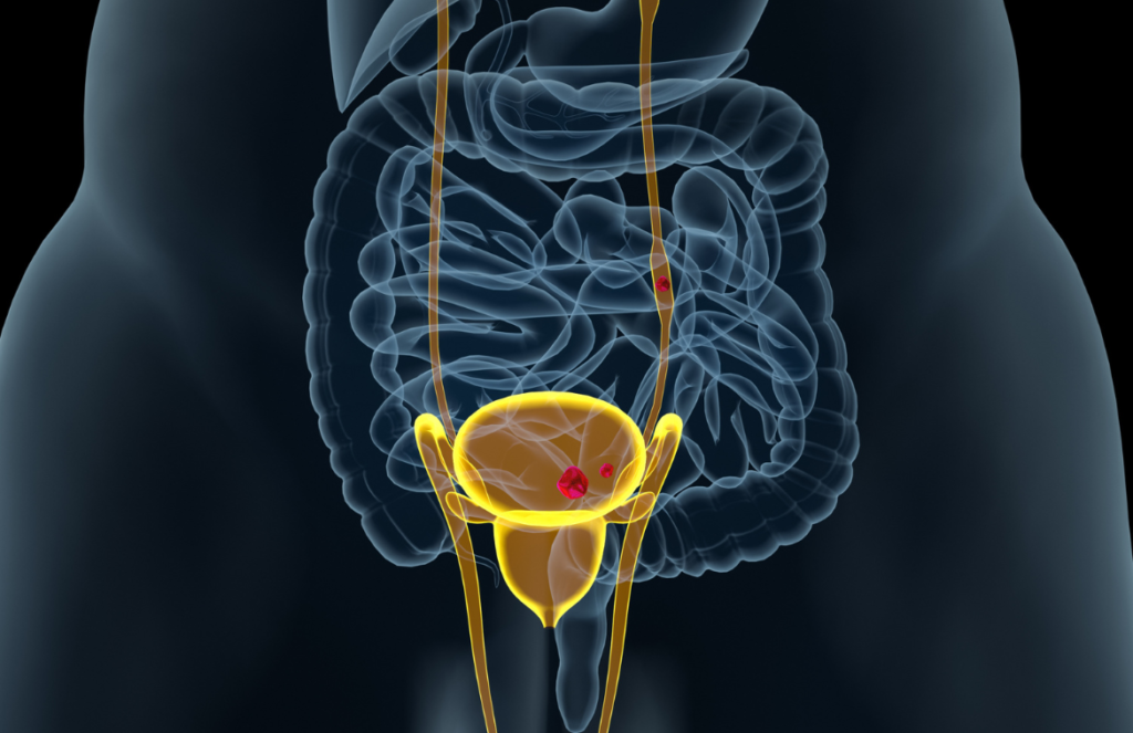 The Six Secrets of Urinary Tract Infection