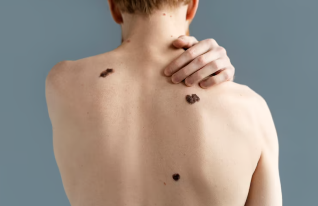 What are the top five homeopathic wart treatments?