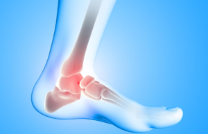 Tumor (Bone): Symptoms, Treatment, Causes and Stages