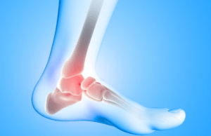 Tumor (Bone): Symptoms, Treatment, Causes and Stages