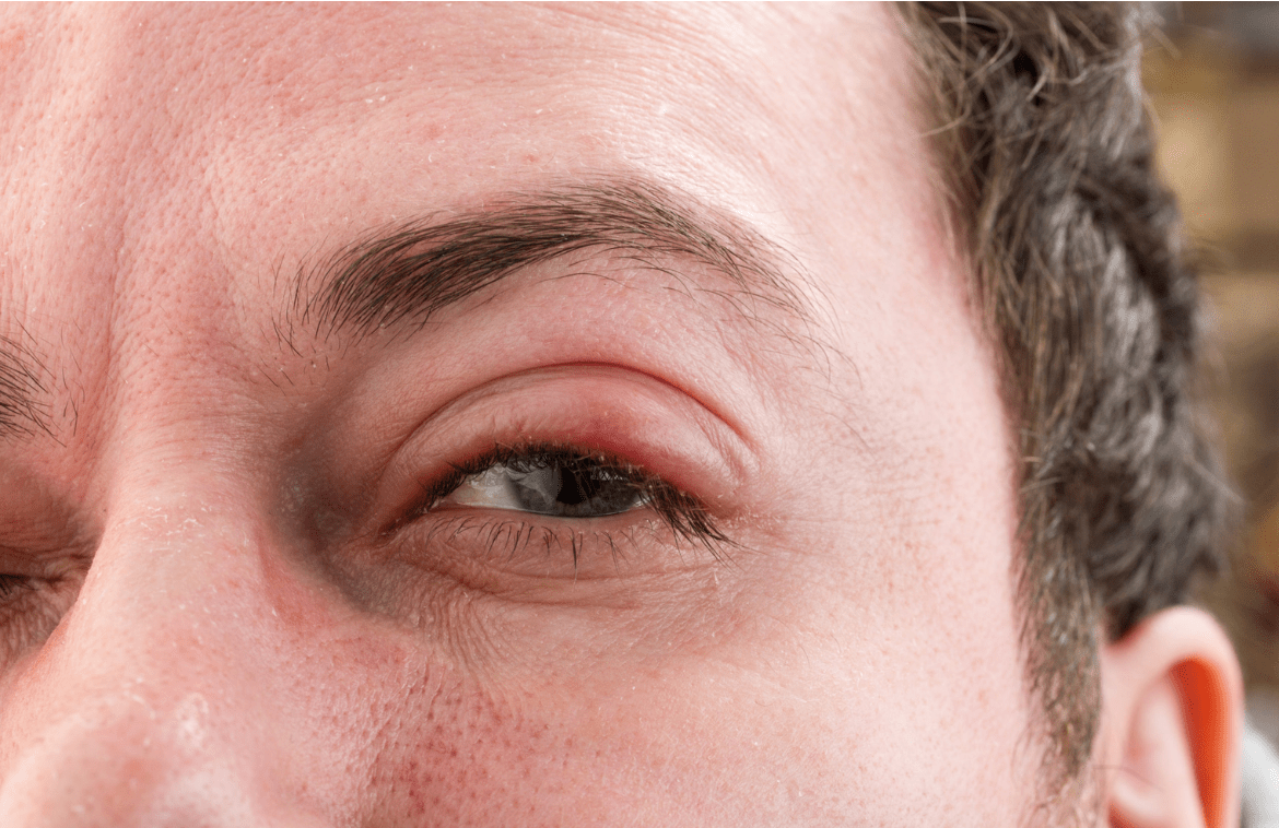 Trachoma: Causes, Symptoms, and Treatment