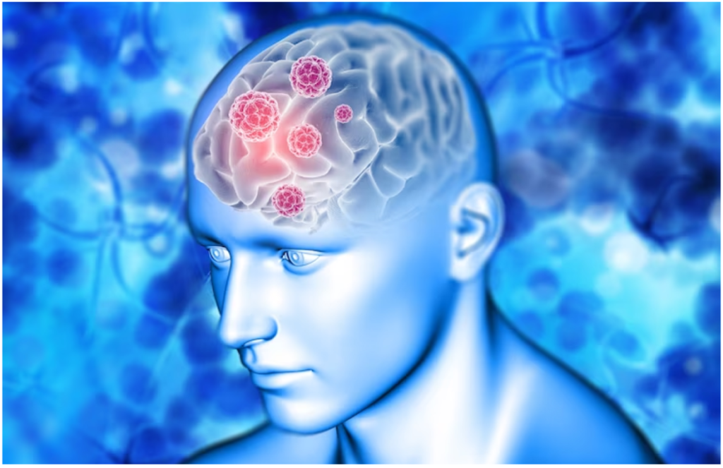 Trigminal Neuralgia Symptoms, Causes and Treatment