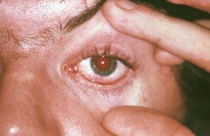 Trachoma: Causes, Symptoms, and Treatment