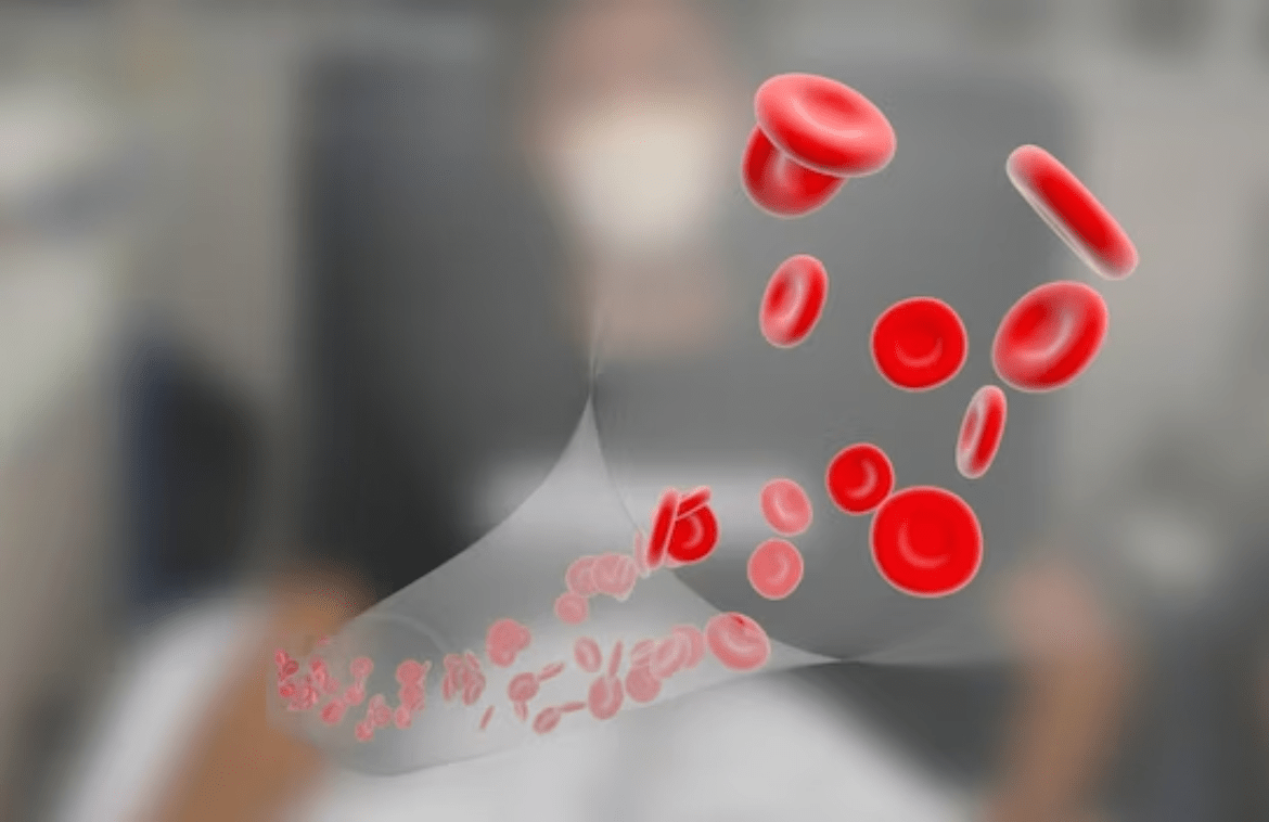 Thalassemia minor- disease and its treatment