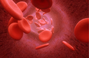 Thalassemia minor- disease and its treatment