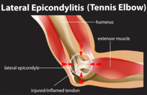 What are Tennis Elbow- symptoms and causes?