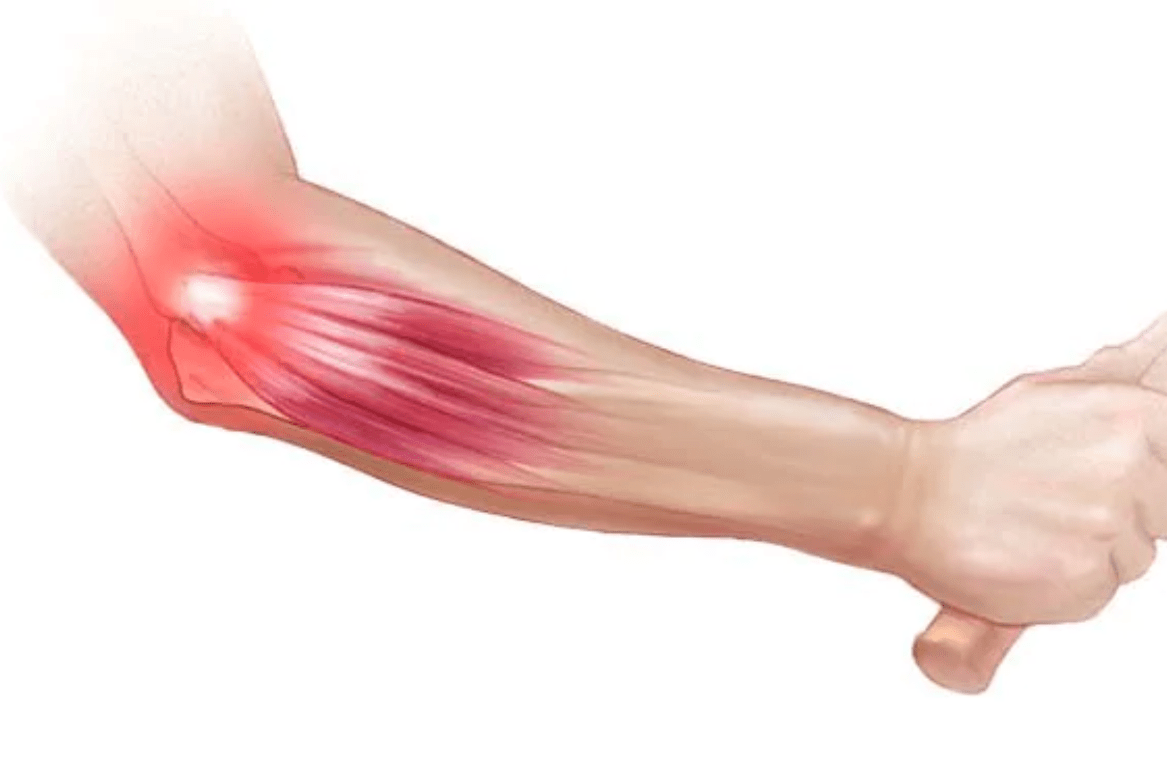 What are Tennis Elbow- symptoms and causes?