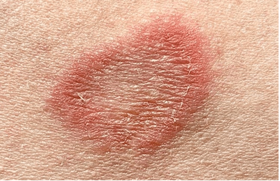 Tinea Corporis in Children, Symptoms, Treatment, Prevention