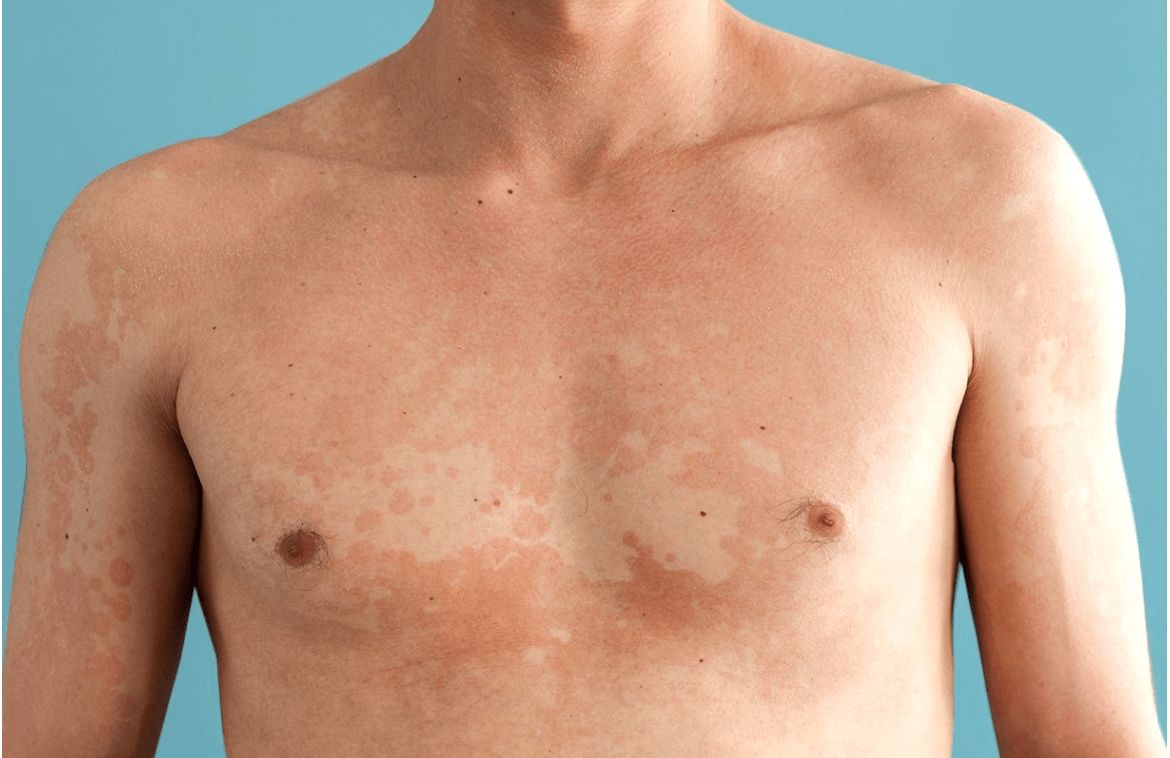 Tinea Versicolor: Symptoms, Causes, and Treatment