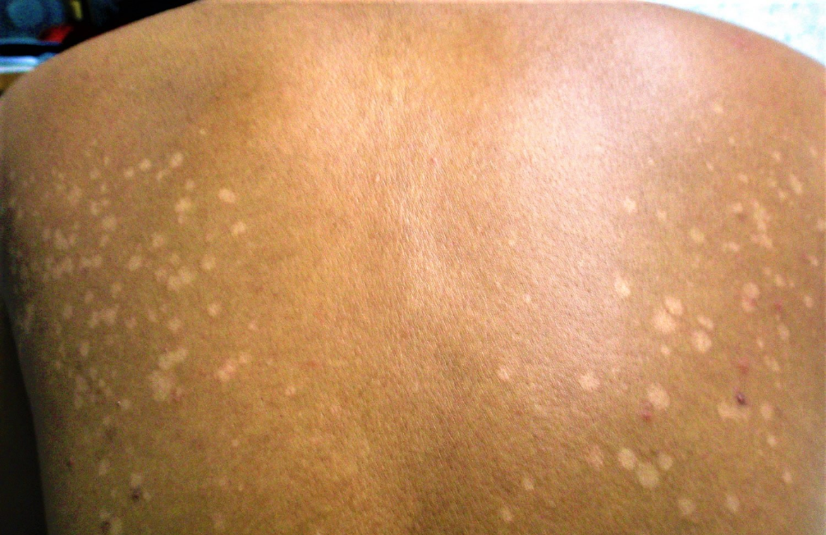 Tinea Versicolor: Symptoms, Causes, and Treatment