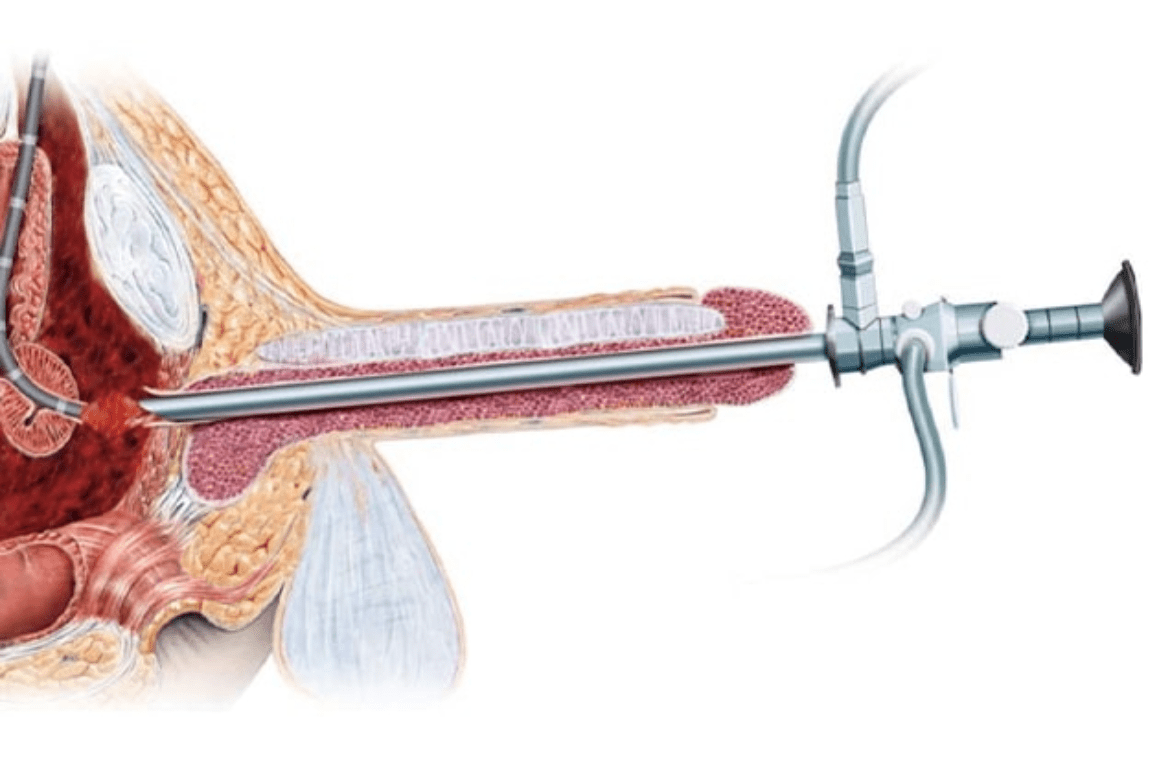 Urethral stricture, causes and treatments available