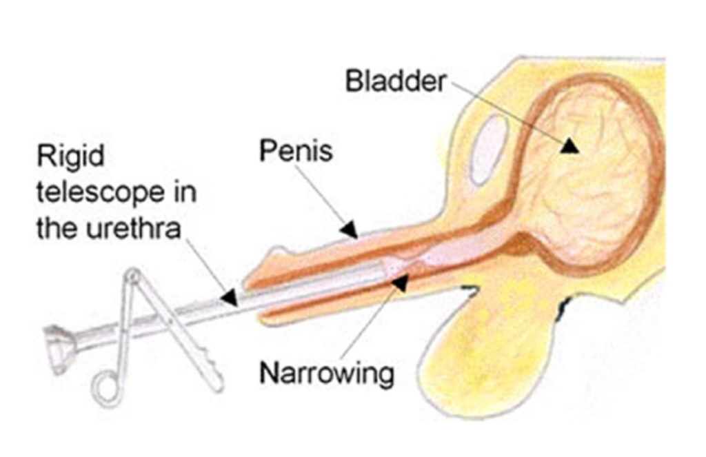 Urethral stricture, causes and treatments available