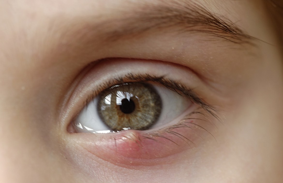 The causes and treatment of Stye