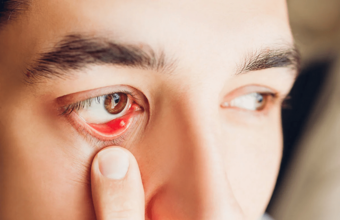 The causes and treatment of Stye