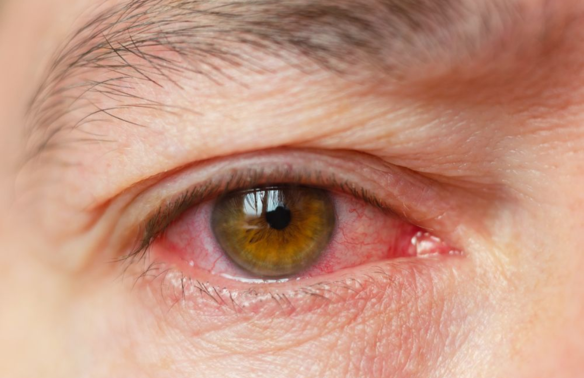 What is uveitis? Symptoms, Causes, and Treatment