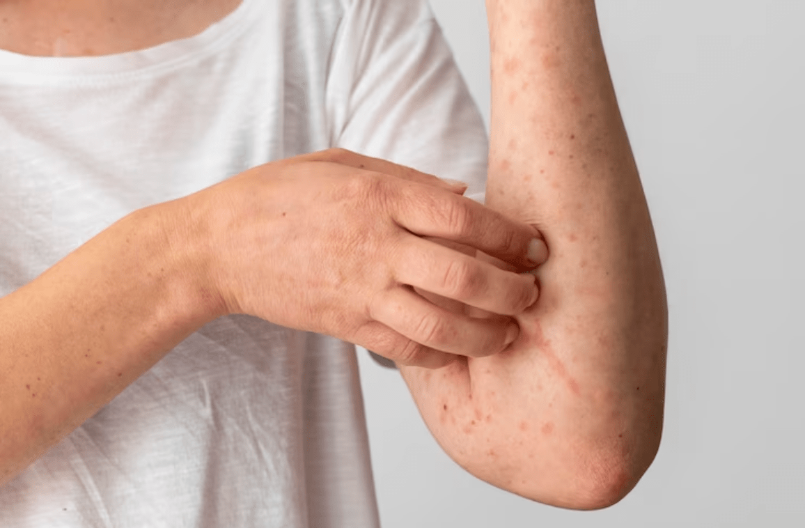 Urticaria Pigmentosa Symptoms & Treatments