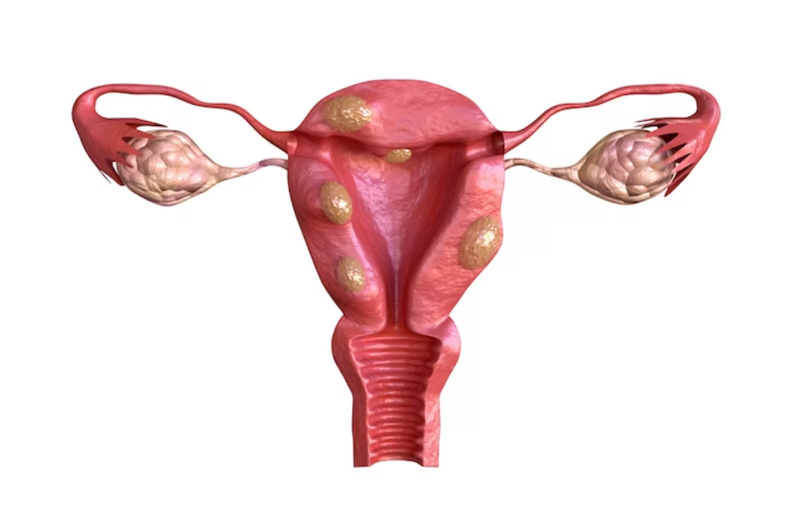 Uterine fibroids- symptoms, causes, and treatments