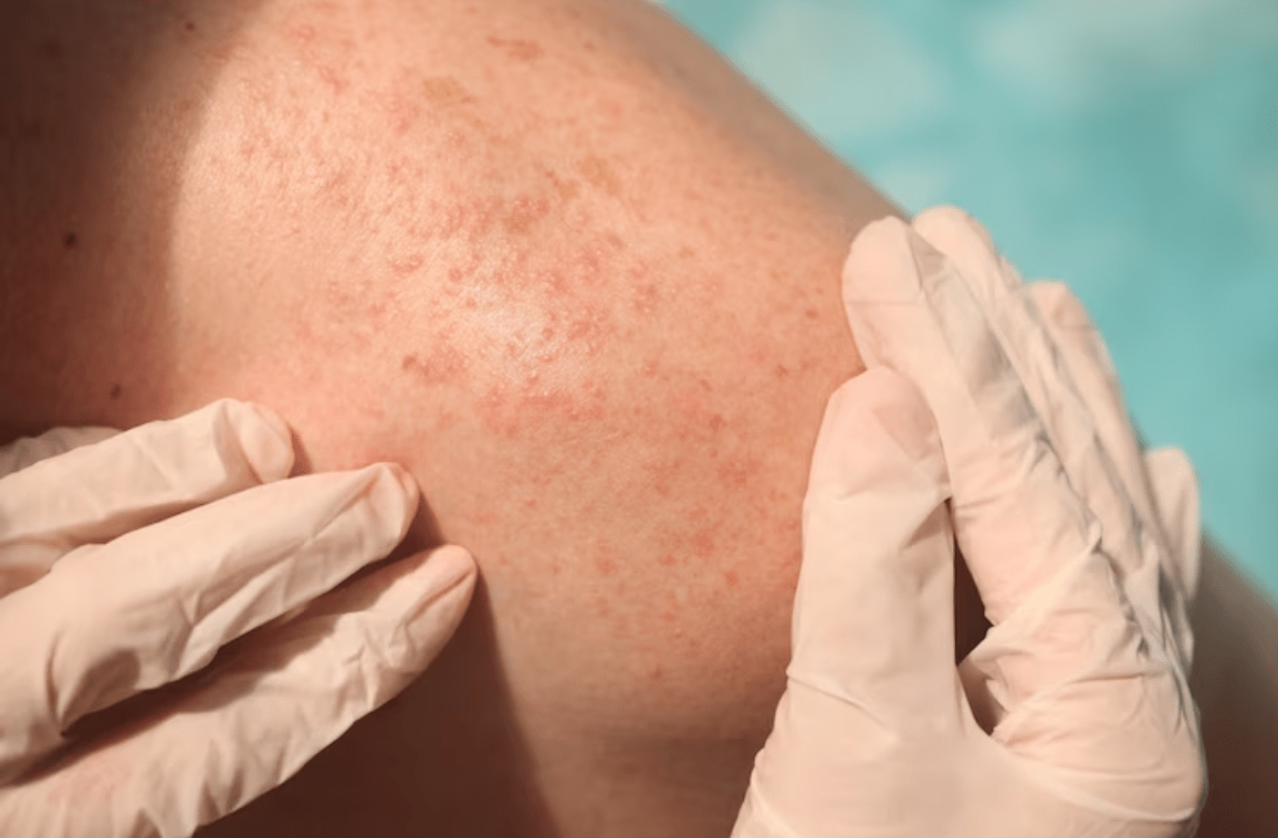 Urticaria: Symptoms, Causes, and Treatment