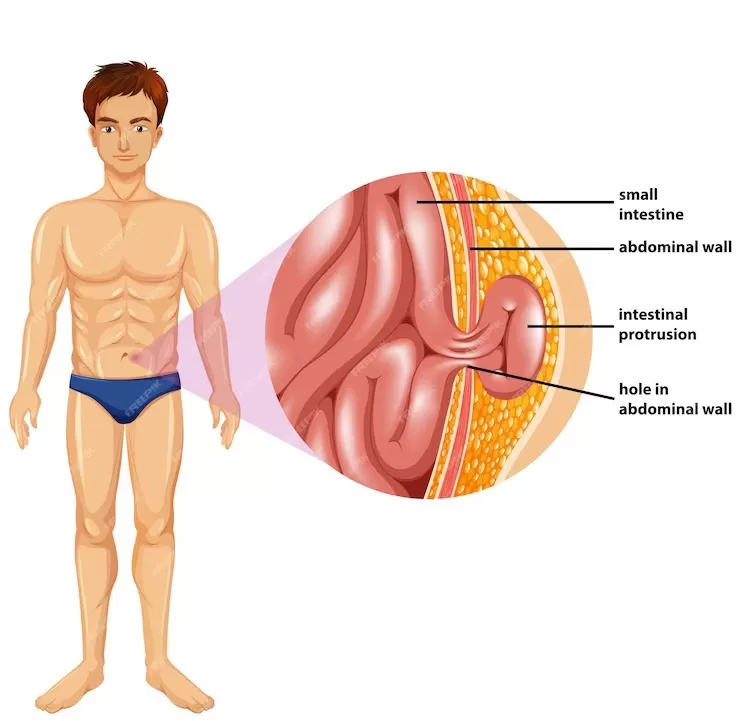 “Heal Naturally: Exploring Homeopathic Treatment for Hernia Recovery”