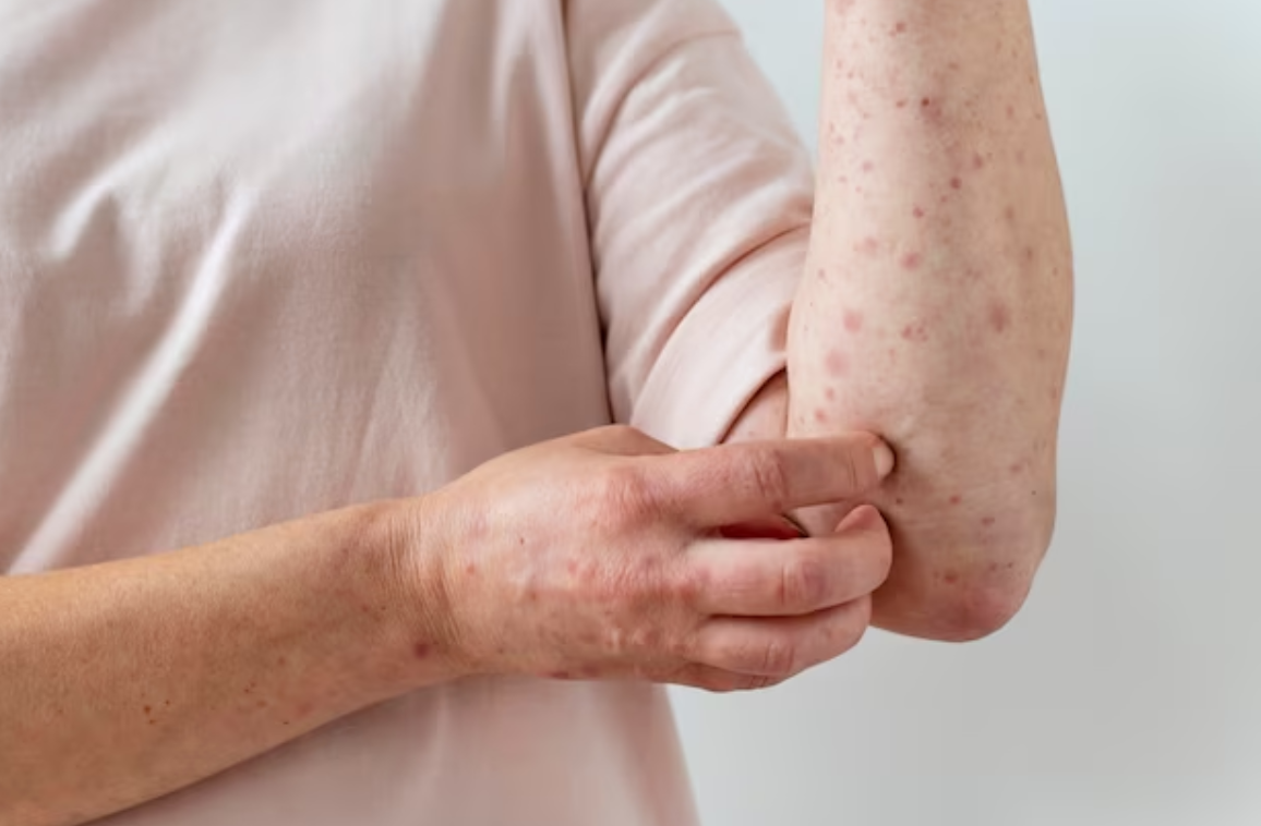 Urticaria: Symptoms, Causes, and Treatment
