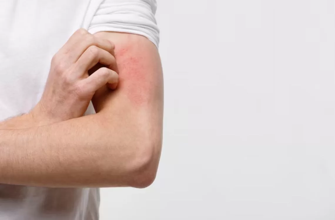 Effectiveness of Homeopathic Medicines in Cases of Urticaria