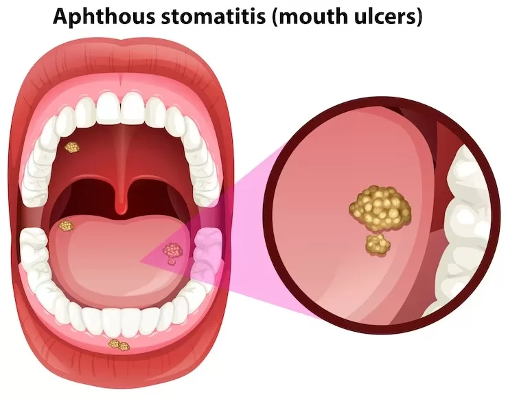 Mouth Ulcers