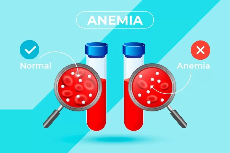 Ferrum Metallicum: Best Homeopathic Medicine for Anemia