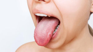 Mouth Ulcers