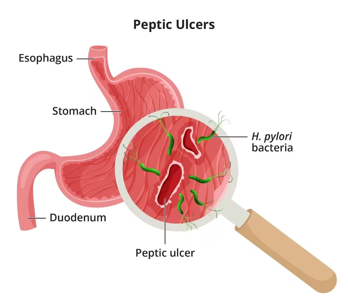 Peptic Ulcers