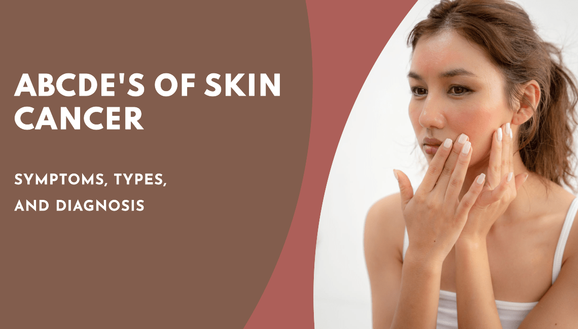 The ABCDEs of Skin Cancer: Symptoms, Types, and Diagnosis